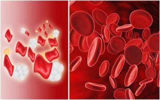 Mức độ nguy hiểm của bệnh Thalassemia và cách tầm soát sớm